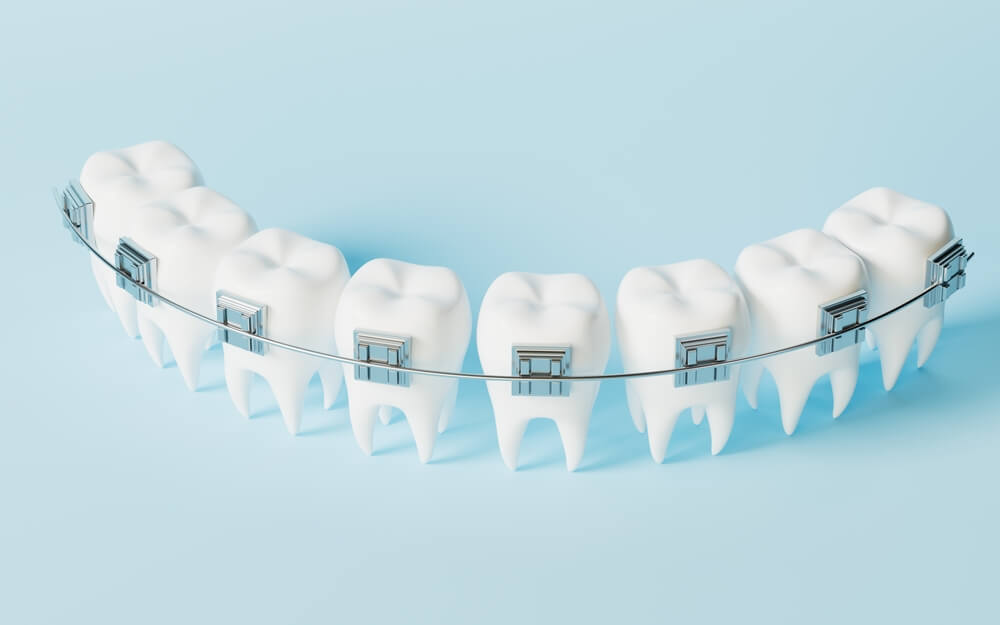 dental braces on model teeth