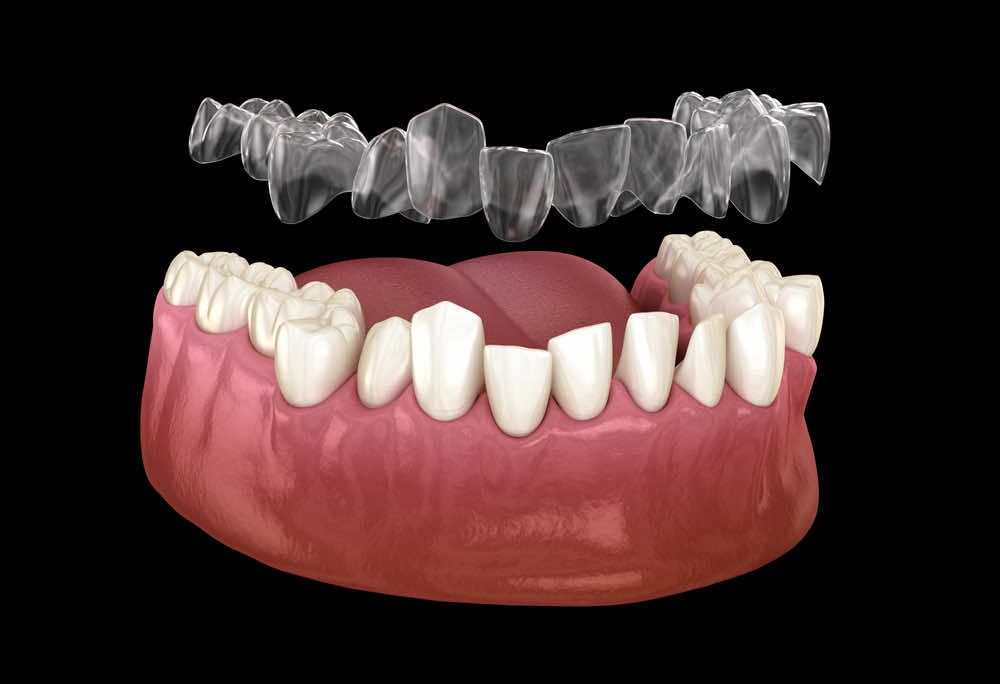 invisible-aligner-on-a-dental-set