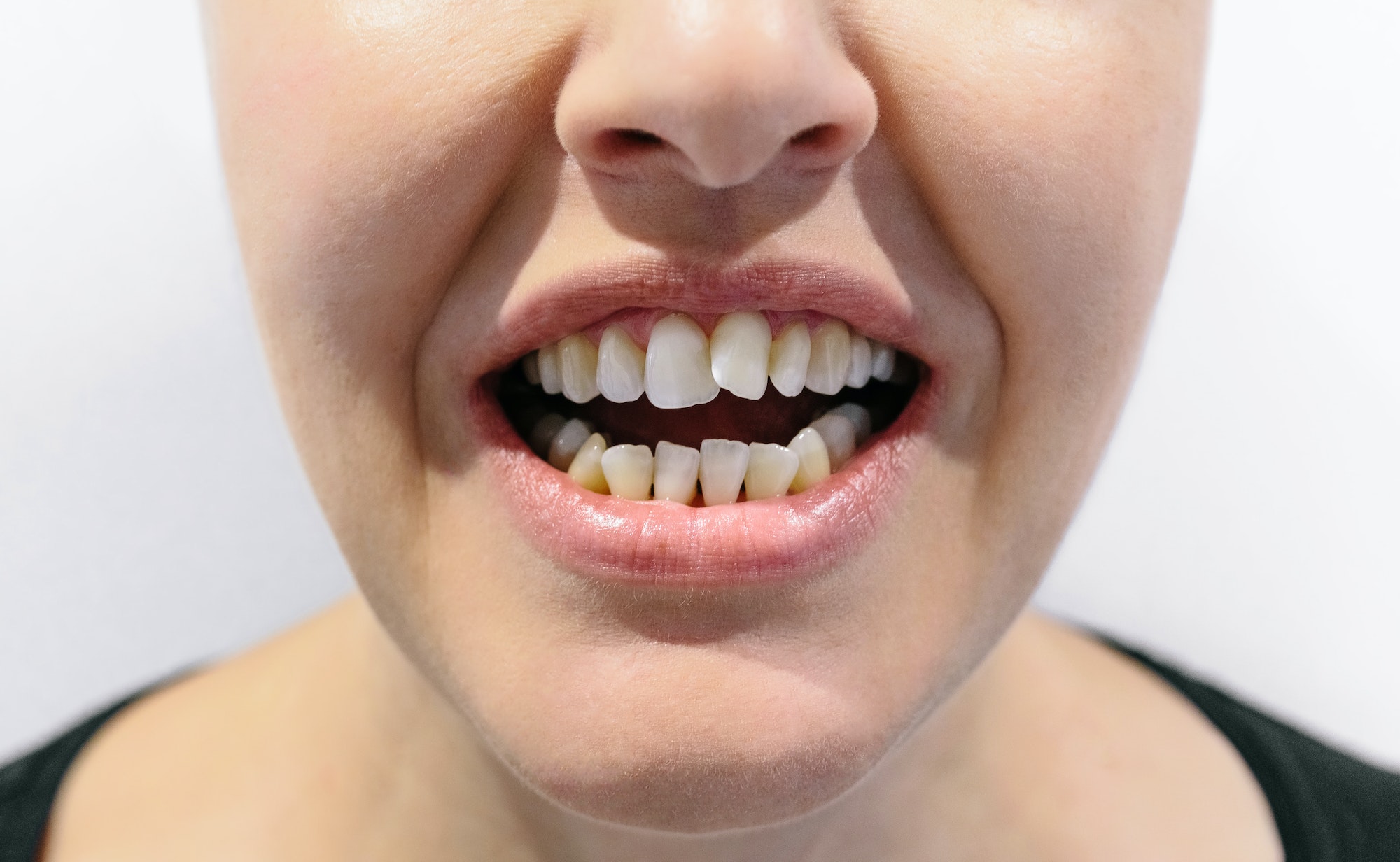 woman-open-mouth-with-crooked-teeth